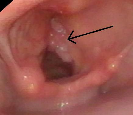 laryngeal papillomatosis.jpg