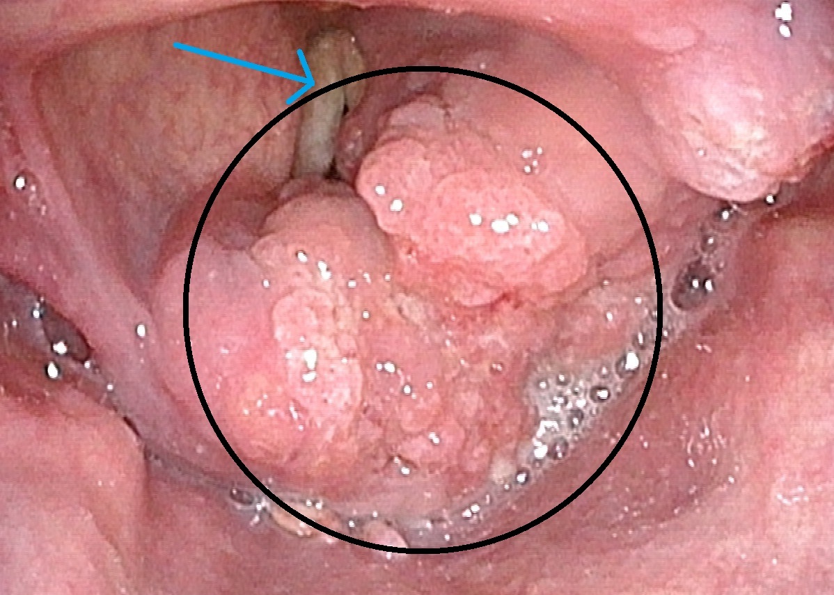 T4 larynx cancer.jpg