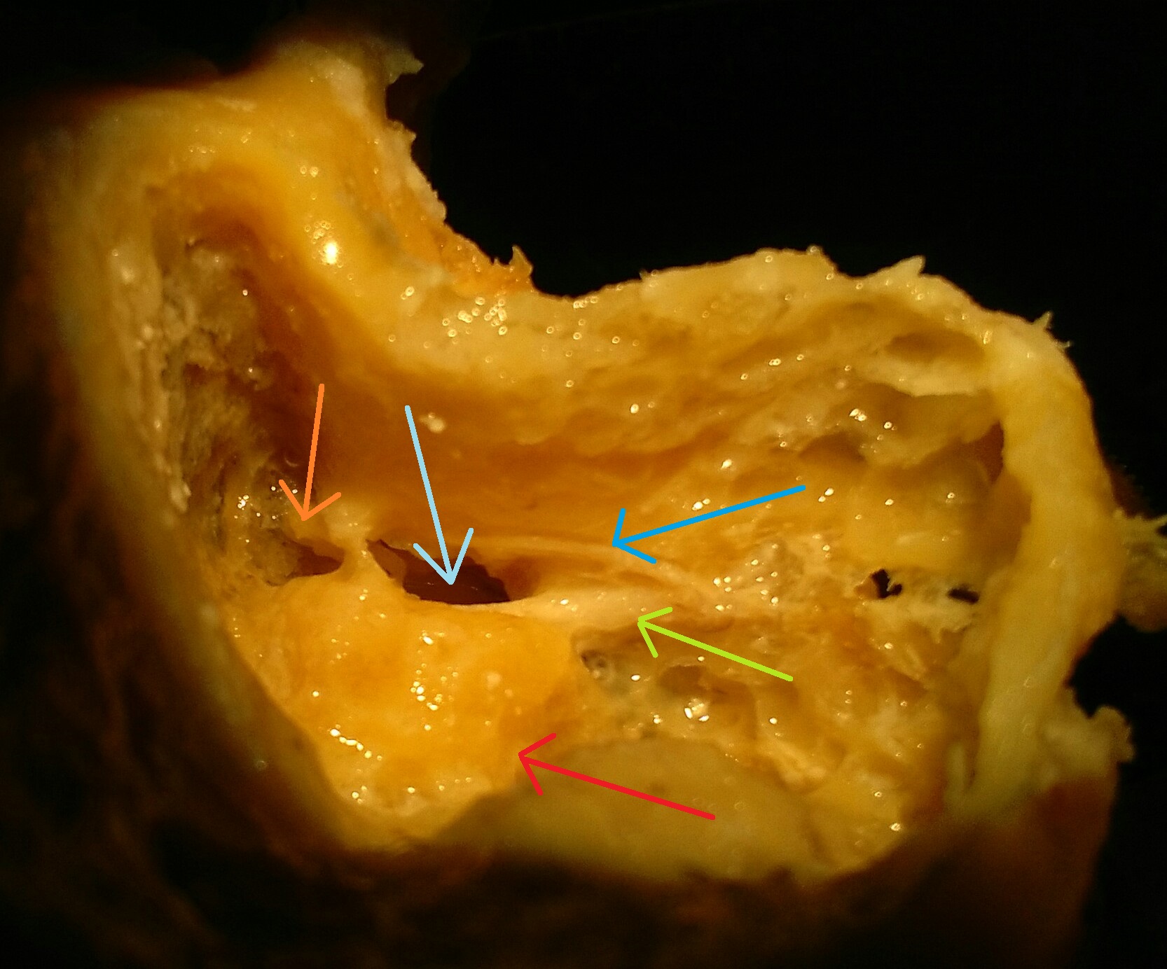 posterior_tympanotomy.jpg