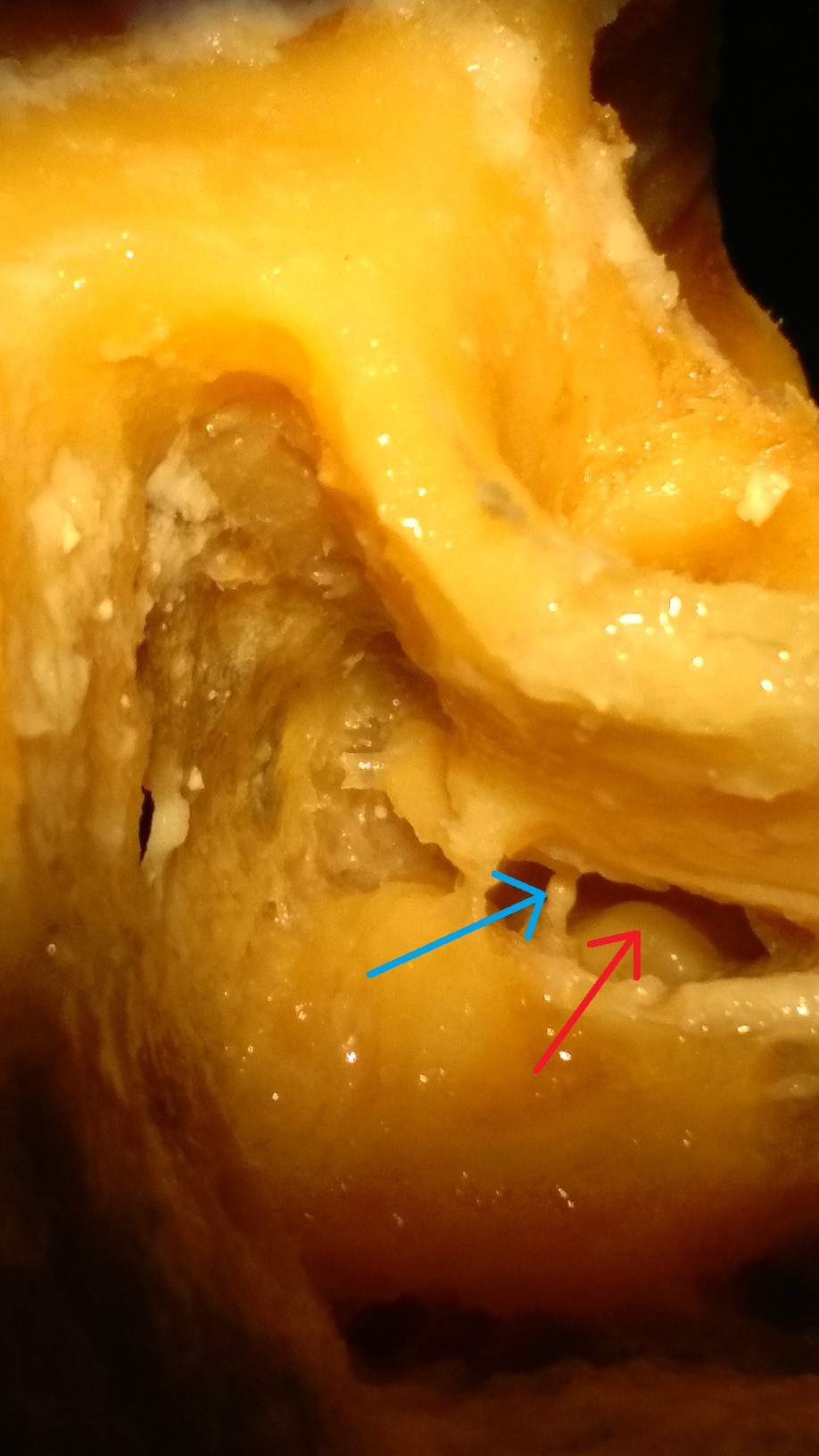 posterior_tympanotomy_promontorium.jpg