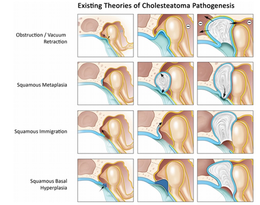 cholesteatoma_pathogenesis_theories.jpg