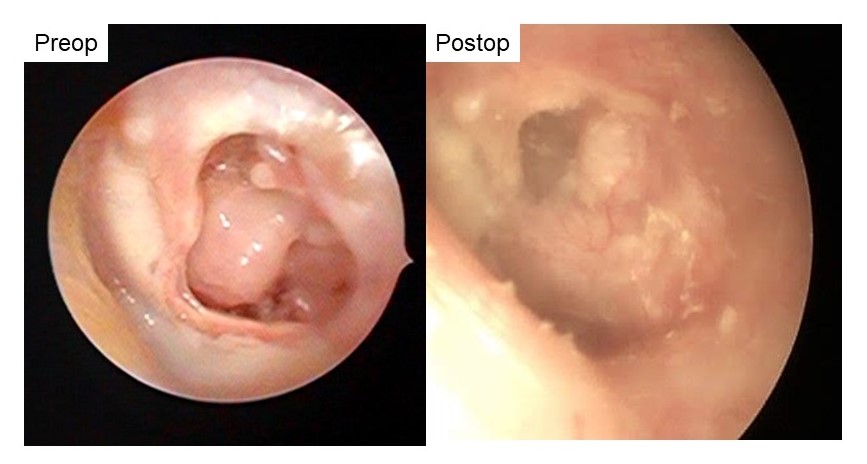 endoscopic_middle_ear_surgery_mesotympanic_otitis_2.JPG