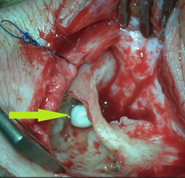 residual_cholesteatoma.jpg