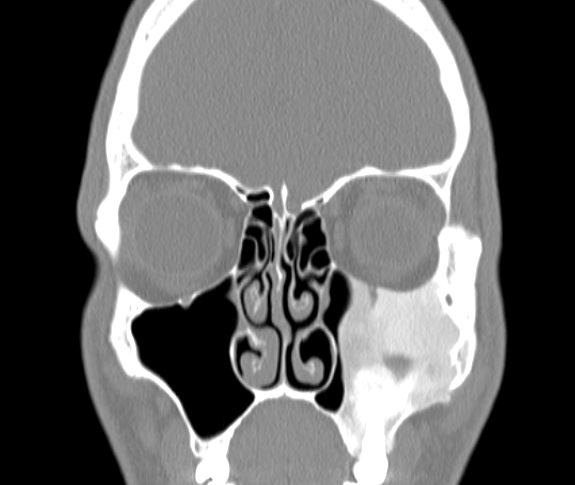 fibrosus dysplasia coronalis01.jpg