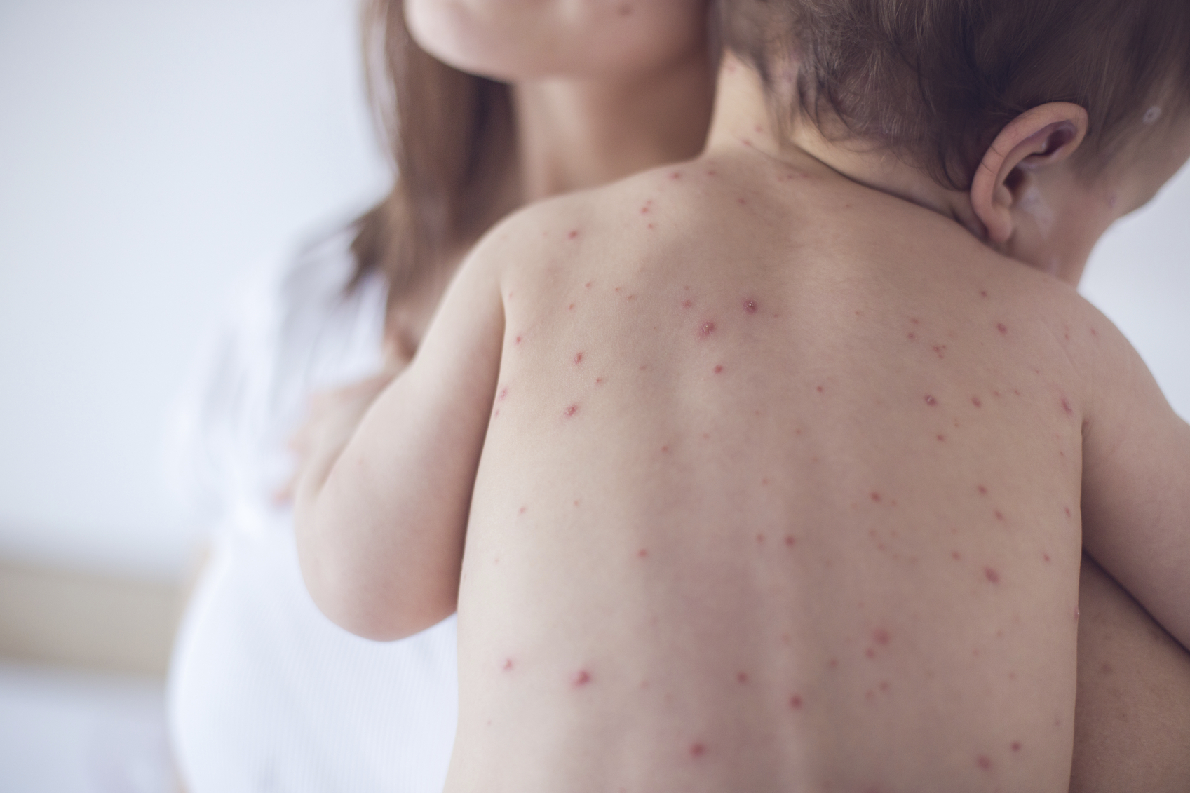 measles2.jpg