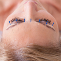 Fejfájásra akupunktúra? Igen
