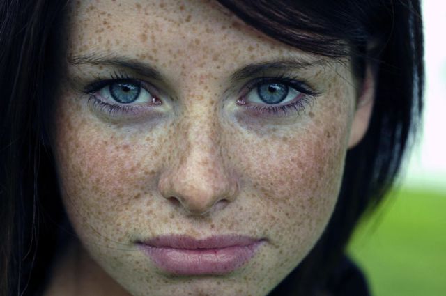 freckles-1.jpg