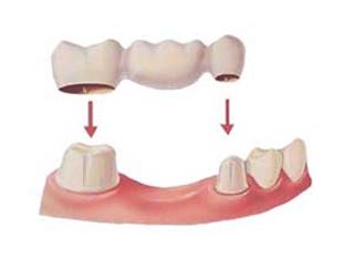 dental-bridges.jpg