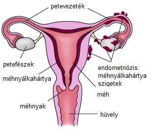 endometriosis2.jpg