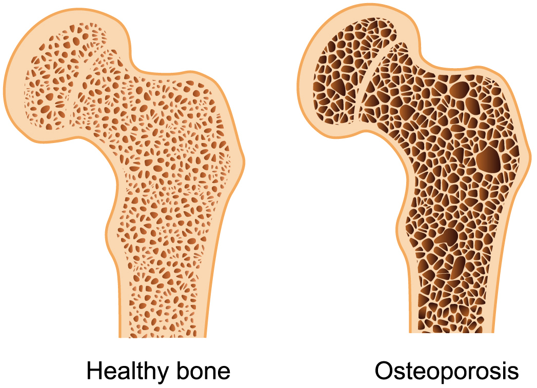 ostoeporosis.jpg