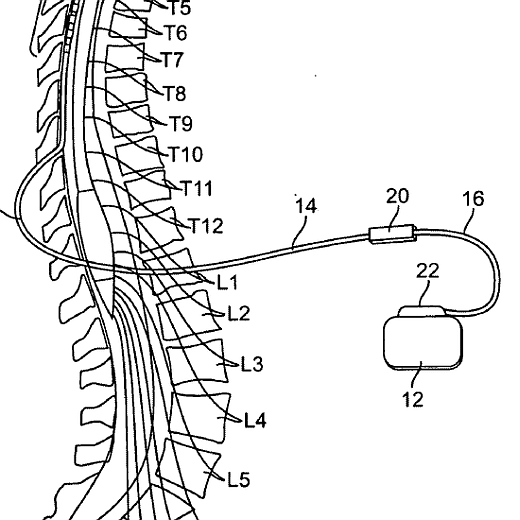 gerinces_neuroszimulator_anatomia_blog.jpg.png