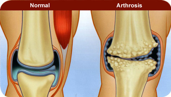 arthrosis050.jpg