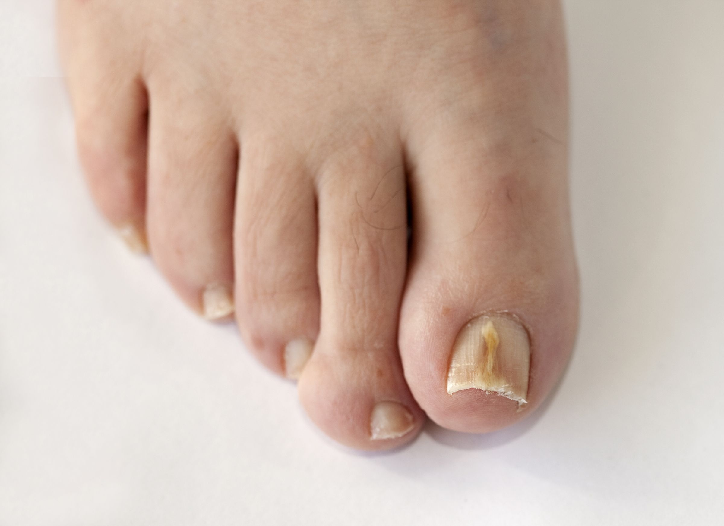 fungal-nail-infection1.jpg