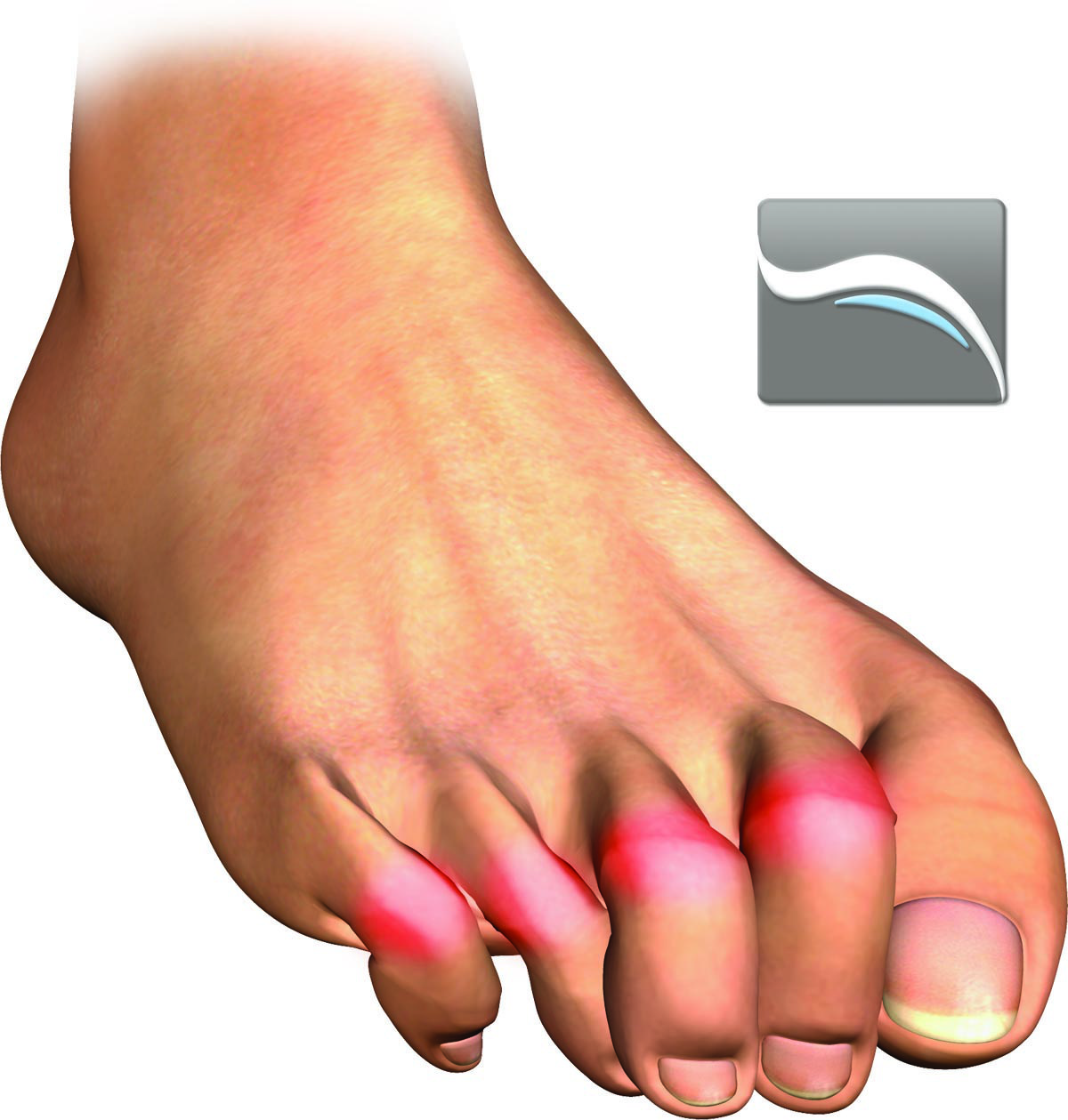 hammertoe-external.jpg