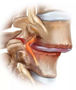 sportserules_108_csigolya_spondylolisthesis_x400-254x300.jpg
