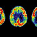 A transzkraniális mágneses stimuláció lassítja az Alzheimer-kórt