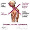 Felső Keresztezett Syndroma (UCS)