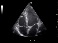 200px-ultrasound_of_human_heart_apical_4-cahmber_view.gif