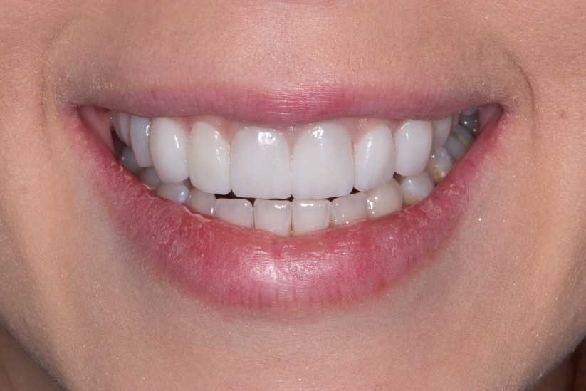 smile-dental-veneers_t20_prydgd.jpg