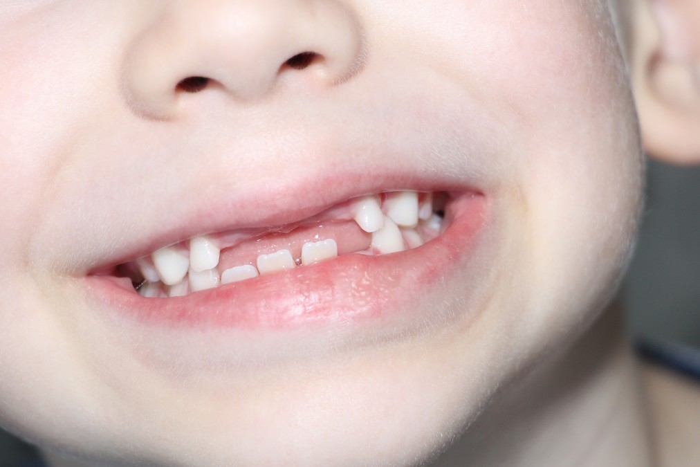 the-boy-smiles-his-milk-teeth-are-visible-loss-of-milk-teeth-the-boy-has-no-upper-central-teeth-the_t20_vr2686.jpg