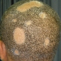 Alopecia