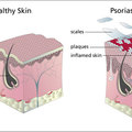 A psoriasis terápiás kezelése 4.