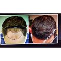 Fue Hair transplant 2171 grafts. Dr. Sikos's result
FUE hajbeültetés 2171 graft Sikos dr. páciense