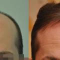 Fue hajbeültetés természetes és igen hatásos eredménye nagy kiterjedésű hajhiány esetén