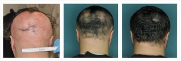 Alopecia areata kezelés.jpg