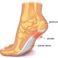 Talp fájdalmak (talpi bőnye gyulladás, plantar fasciitis)