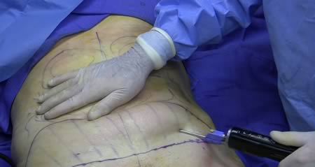 a98767_first-plastics_5-liposuction.jpg