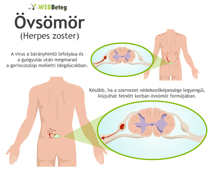 népi gyógyszerek a látás javítására mi a 0 5 d látás?