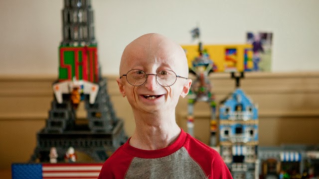 progeria.jpg