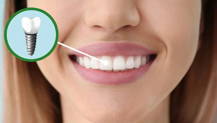 The Benefits of Professional Teeth Whitening by Your Dentist