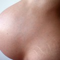 Terhességi csíkok – repedések a bőrön
