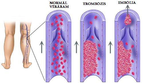 unicafe_hu-a-melyvenas-trombozis-001.jpg