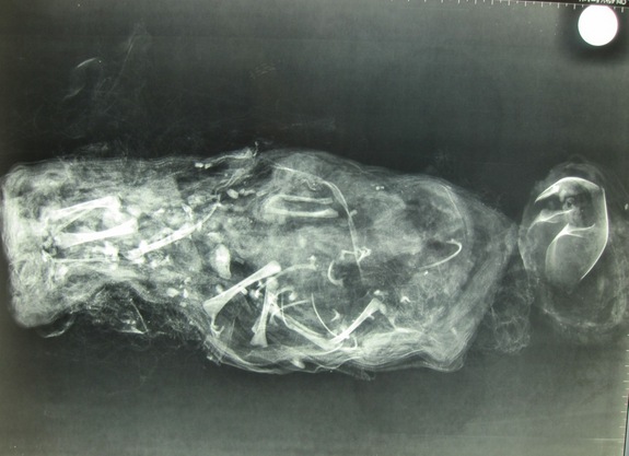 mummified-fetus-2.jpg