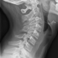 Nyaki-háti gerinc átmenet, oldalirányú felvétel