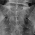 Lumbosacralis gerinc, kétirányú felvétel