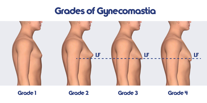 gradesofgynecomastia.jpg