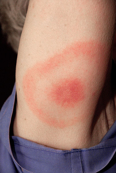 403px-Erythema_migrans_-_erythematous_rash_in_Lyme_disease_-_PHIL_9875.jpg