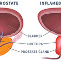A Prosztata Mirigy