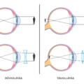 Hova lát jól a rövidlátó és a távollátó?