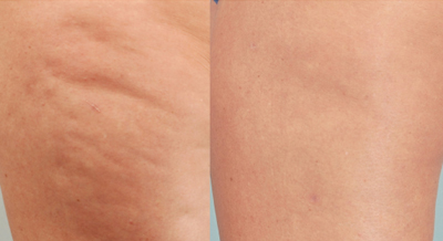 Sima bőr, megszűnt a narancsbőr a Cellulaze kezelés során - kép a kezelés előtt és után