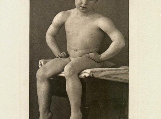 Fotográfia és orvostudomány – Heinrich Curschmann klinikai illusztrációi 1894-ből (18+)