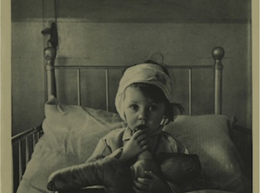 Cecil Beaton: Eileen Dunne, a sebesült kislány (1940)