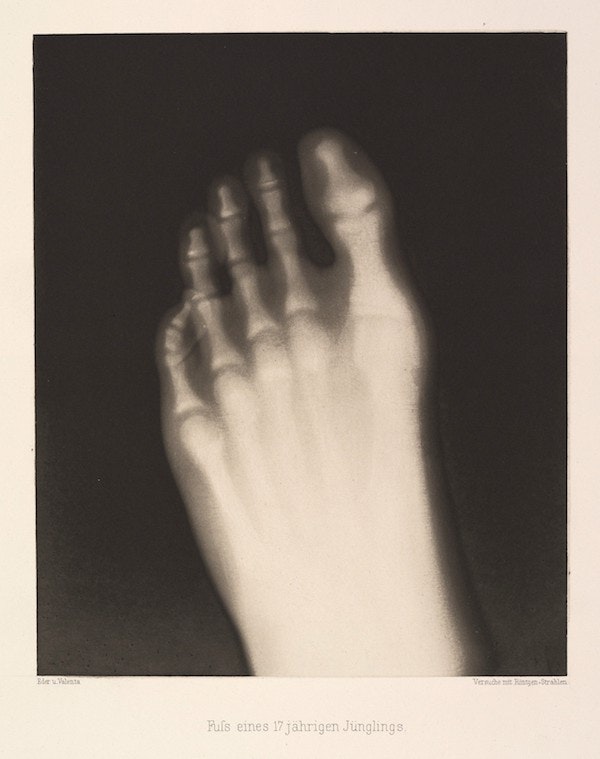 Fotó: Dr. Josef Maria Eder: Egy 17 éves lábfeje, 1896