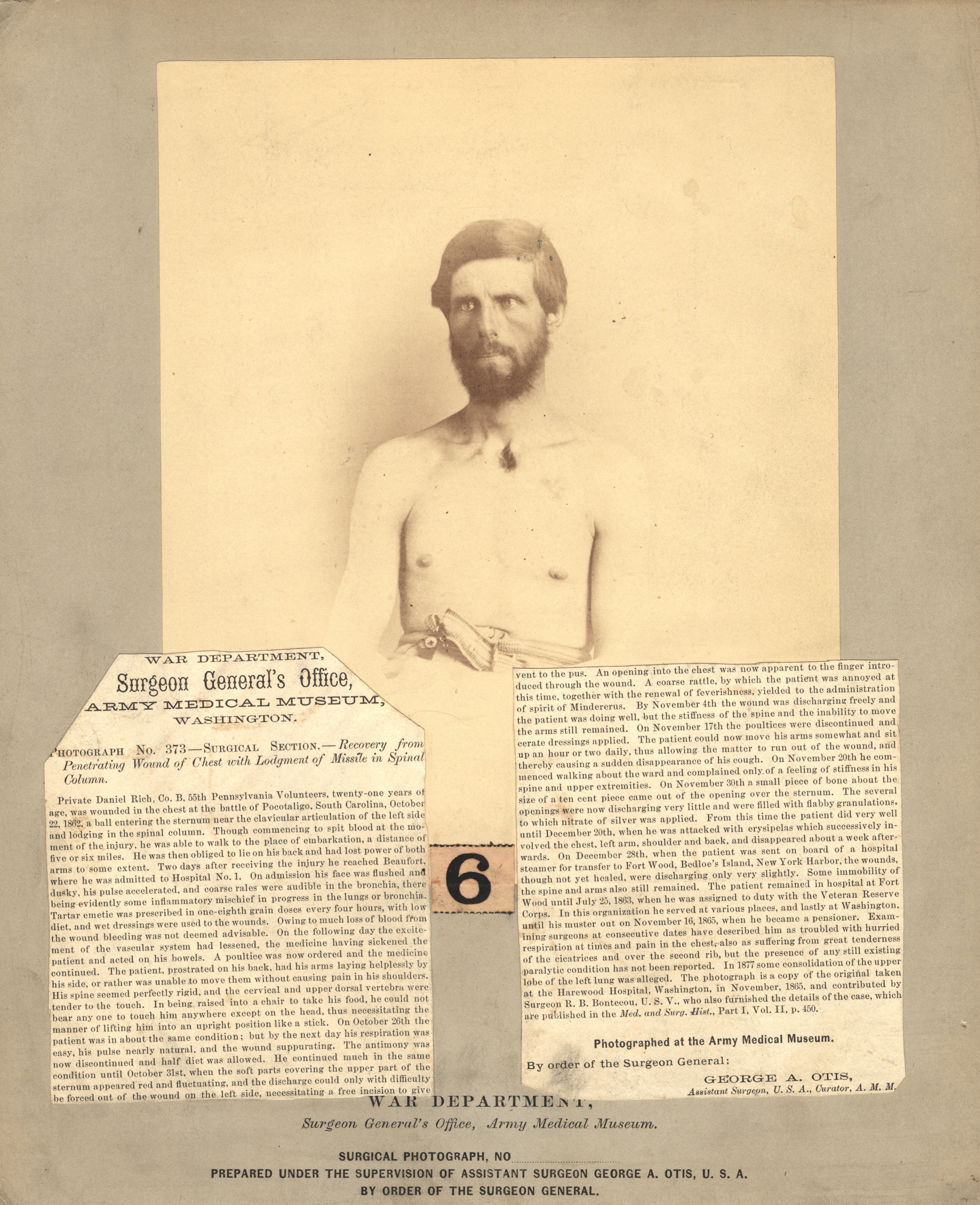 Fotó: Reed B. Bontecou: Daniel Rich, 21 éves közlegény, aki 1862. október 22-én sérült meg a Pocotaligo csatában, The National Library of Medicine