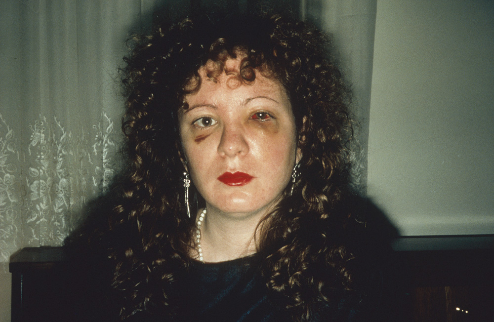 Fotó: Nan Goldin: Heart-Shaped Bruise, New York City, 1980 © Nan Goldin