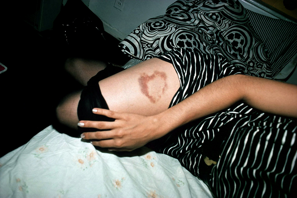 Fotó: Nan Goldin: Heart-Shaped Bruise, New York City, 1980 © Nan Goldin